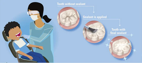 sealants-img